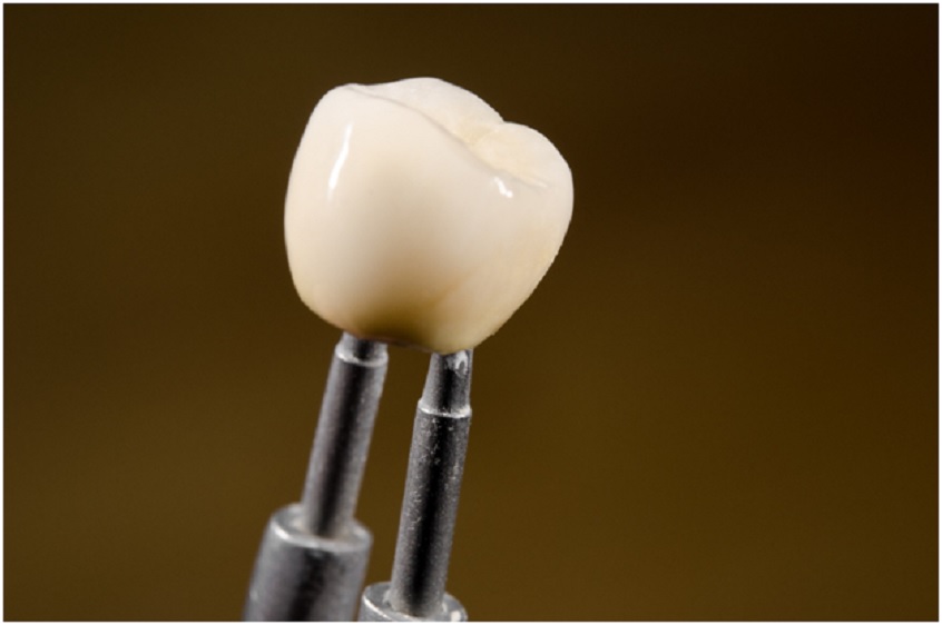 dental-implant2