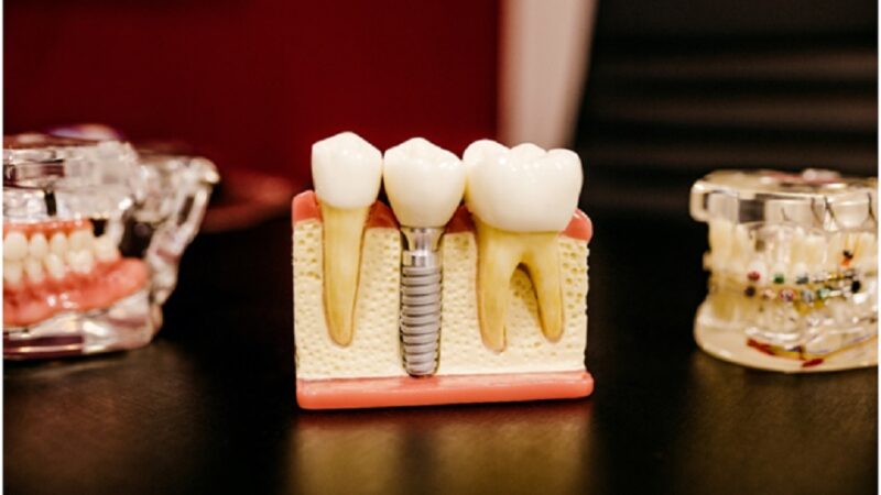 Dental crowns past and present
