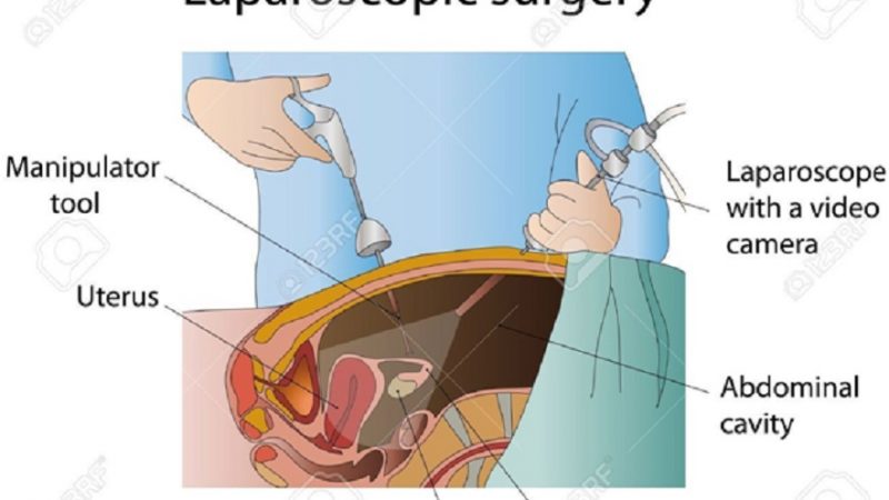 Laparoscopic Surgery Vs. Robotic Surgery