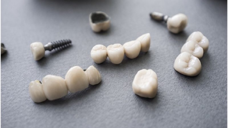 What is all the fuss about regarding All-on-4 dental implant?