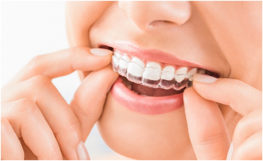 Is there more than one type of Invisalign brace? – orthodontic