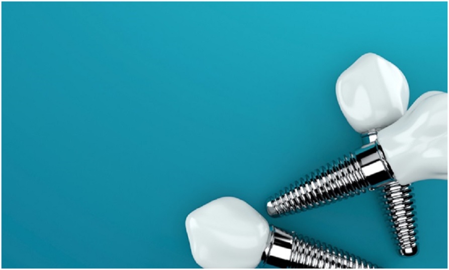 Want to know more about oral implant surgery? 5 top FAQs answered