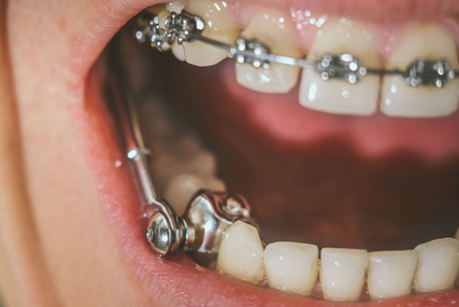 Questions about clear orthodontic appliances answered
